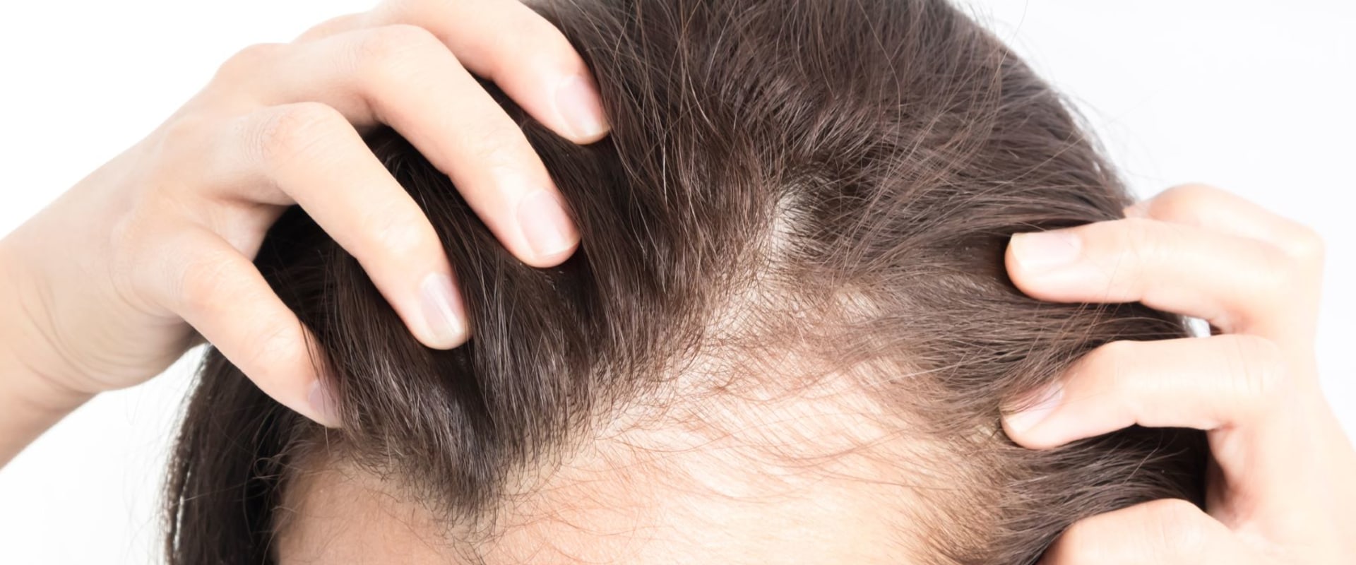 Female Hair Loss: Causes, Prevention, and Treatment