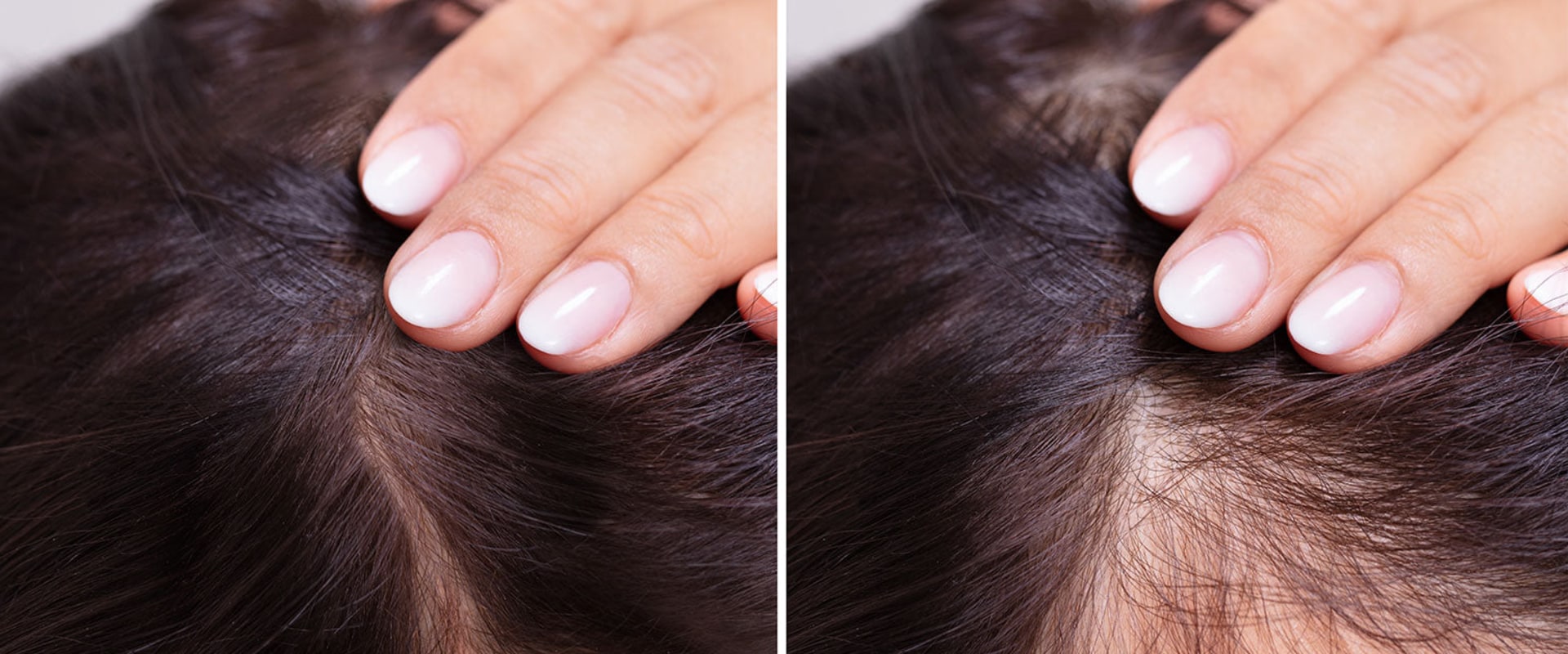 Preventing Baldness and Hair Loss: Tips and Solutions
