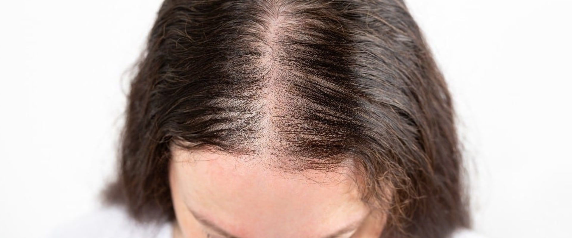 Scalp Care: Understanding Baldness and Hair Loss