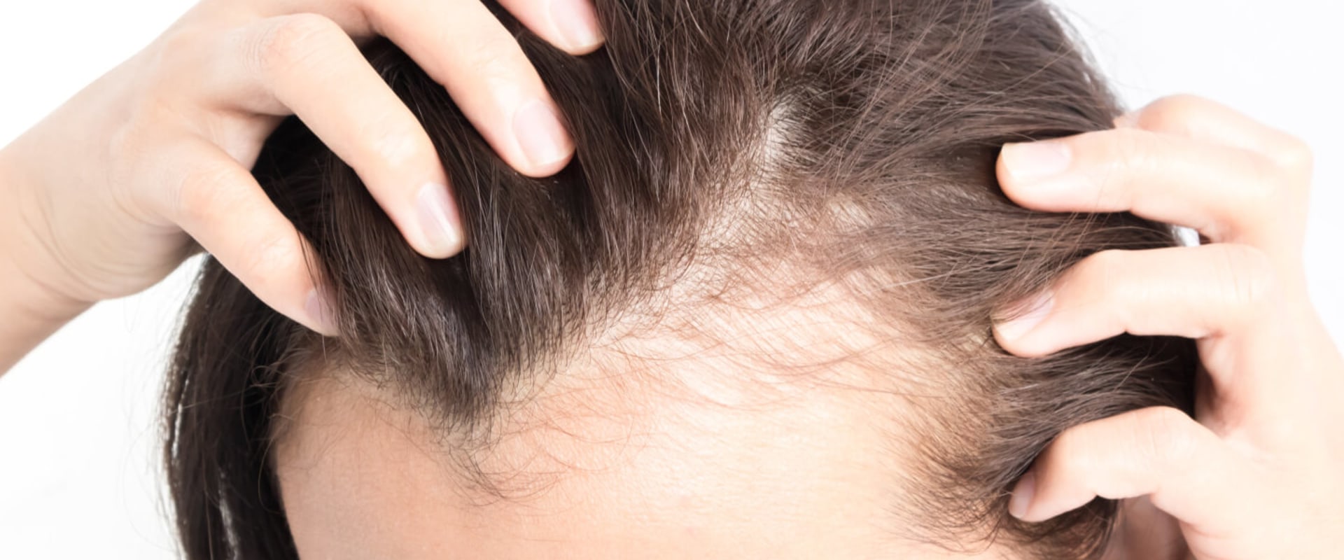 All You Need to Know About Medical Conditions and Female Hair Loss