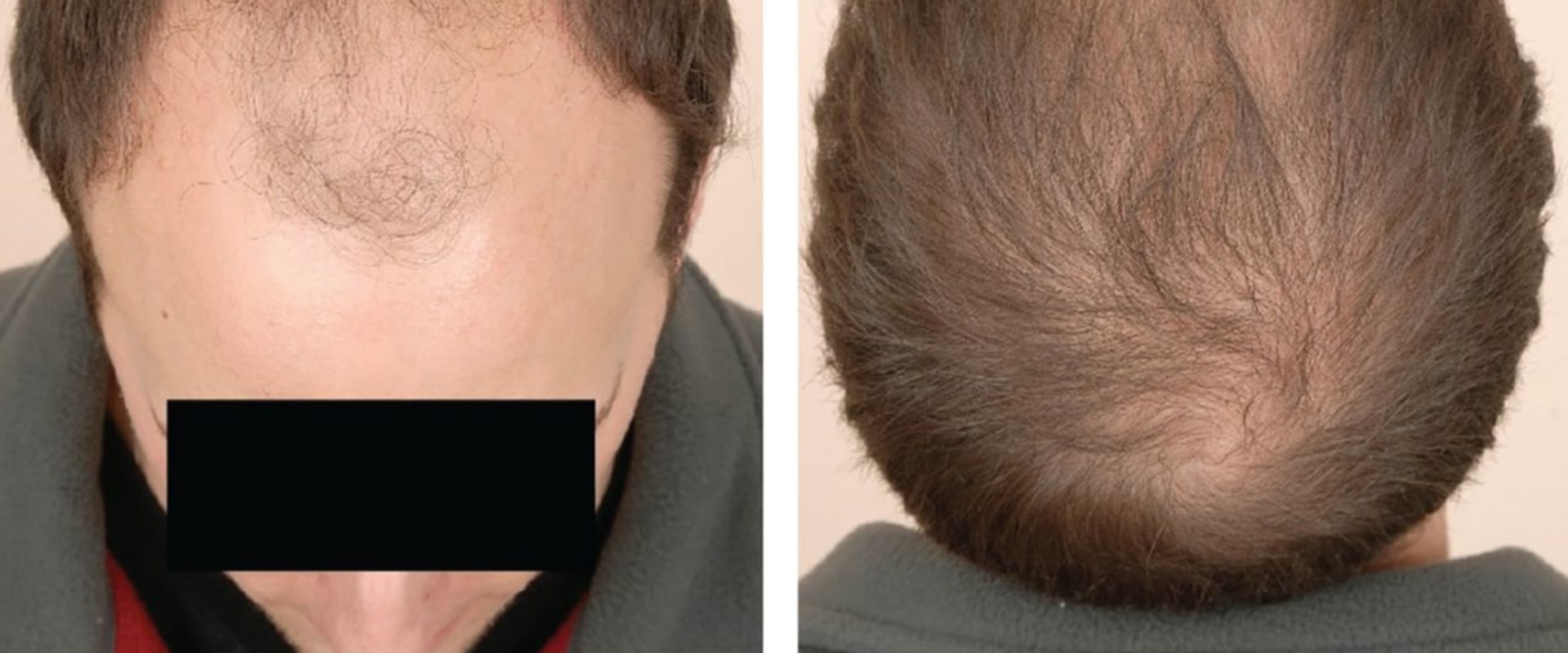 Natural Remedies for Male Pattern Baldness: Tips and Treatments