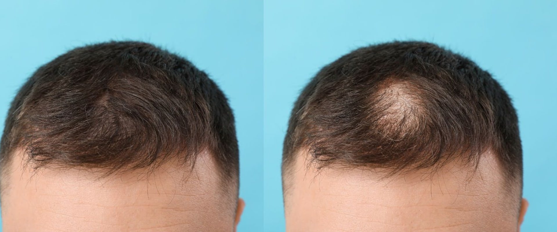 Finasteride: A Comprehensive Guide to Hair Loss Prevention and Treatment