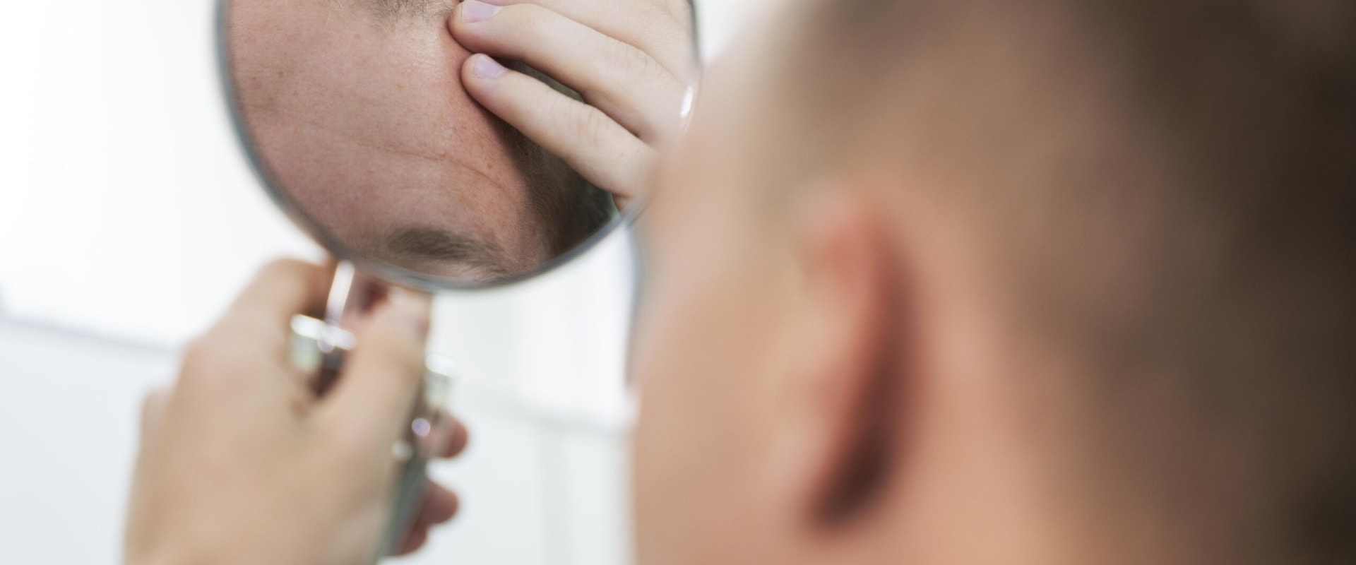 Understanding Genetics and Male Pattern Baldness