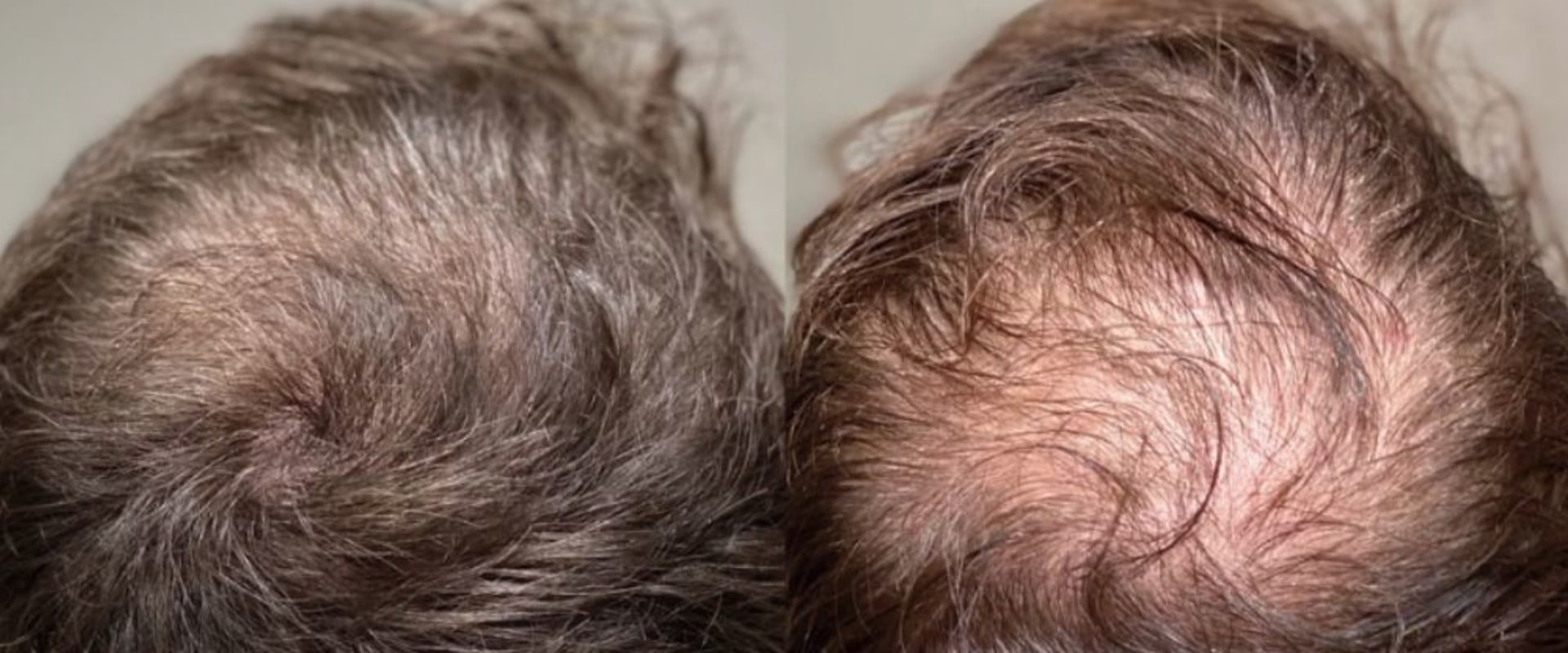 Exercise for Hair Health: Tips and Techniques to Prevent and Treat Hair Loss