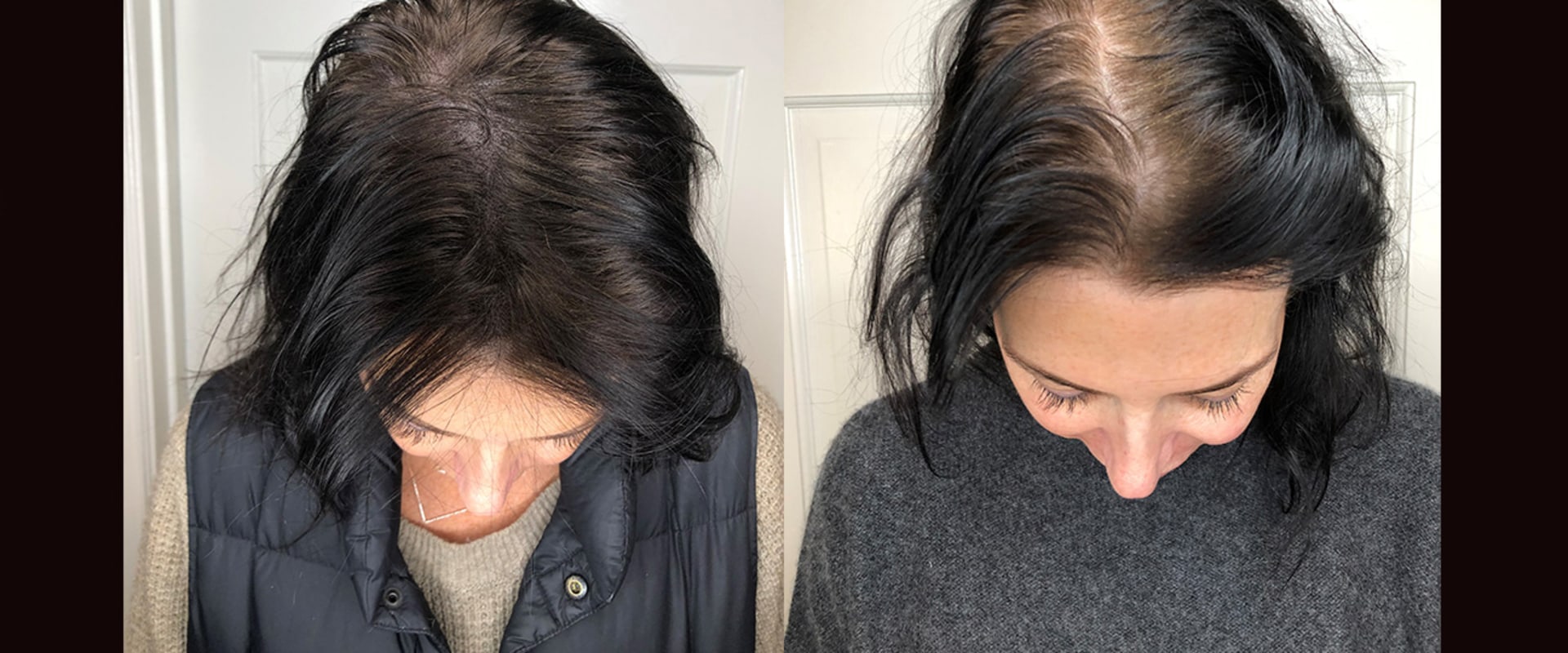 All You Need to Know About Scalp Concealers: Solutions for Hair Loss and Baldness