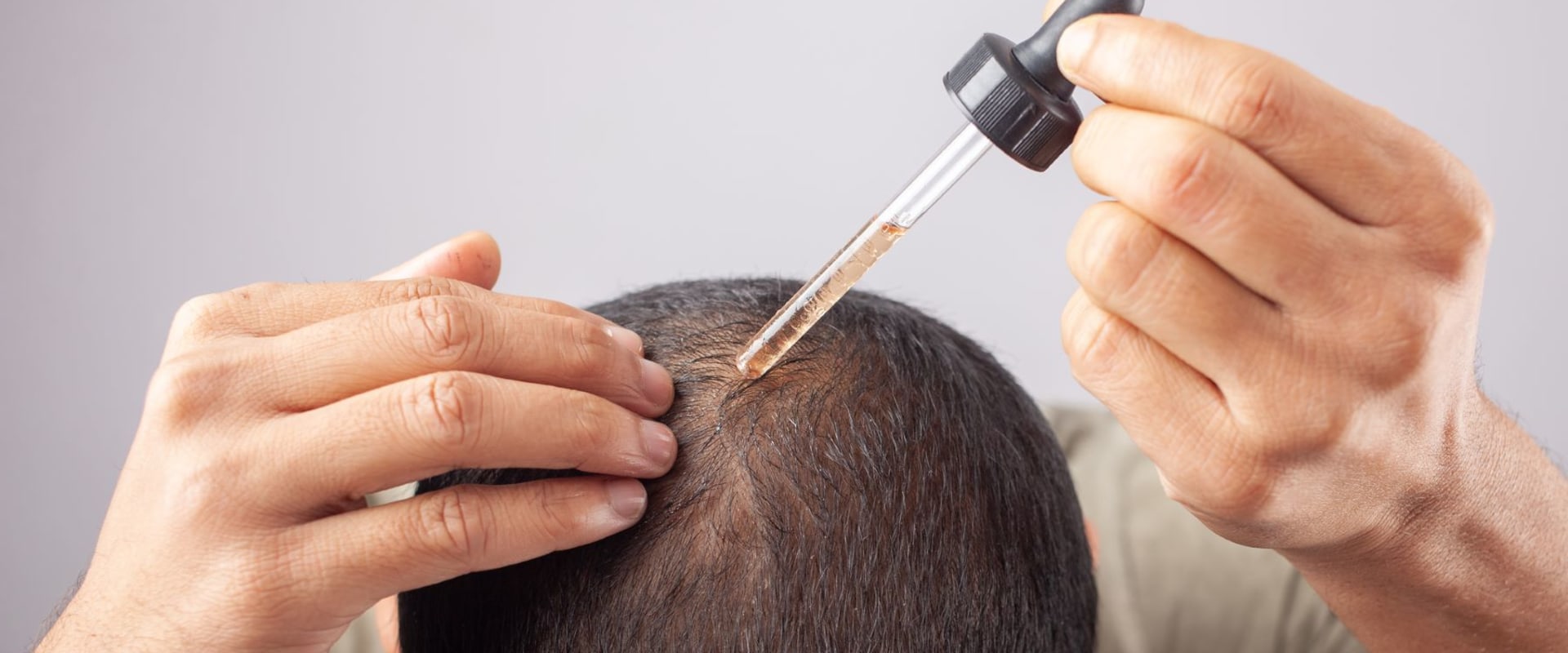Understanding Genetics: The Key to Preventing Baldness and Hair Loss