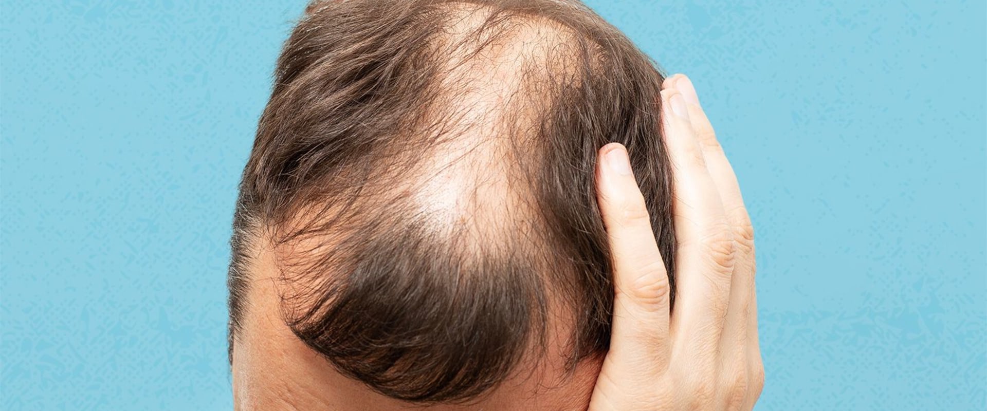 Preventing Baldness and Hair Loss: Understanding the Lifestyle Factors