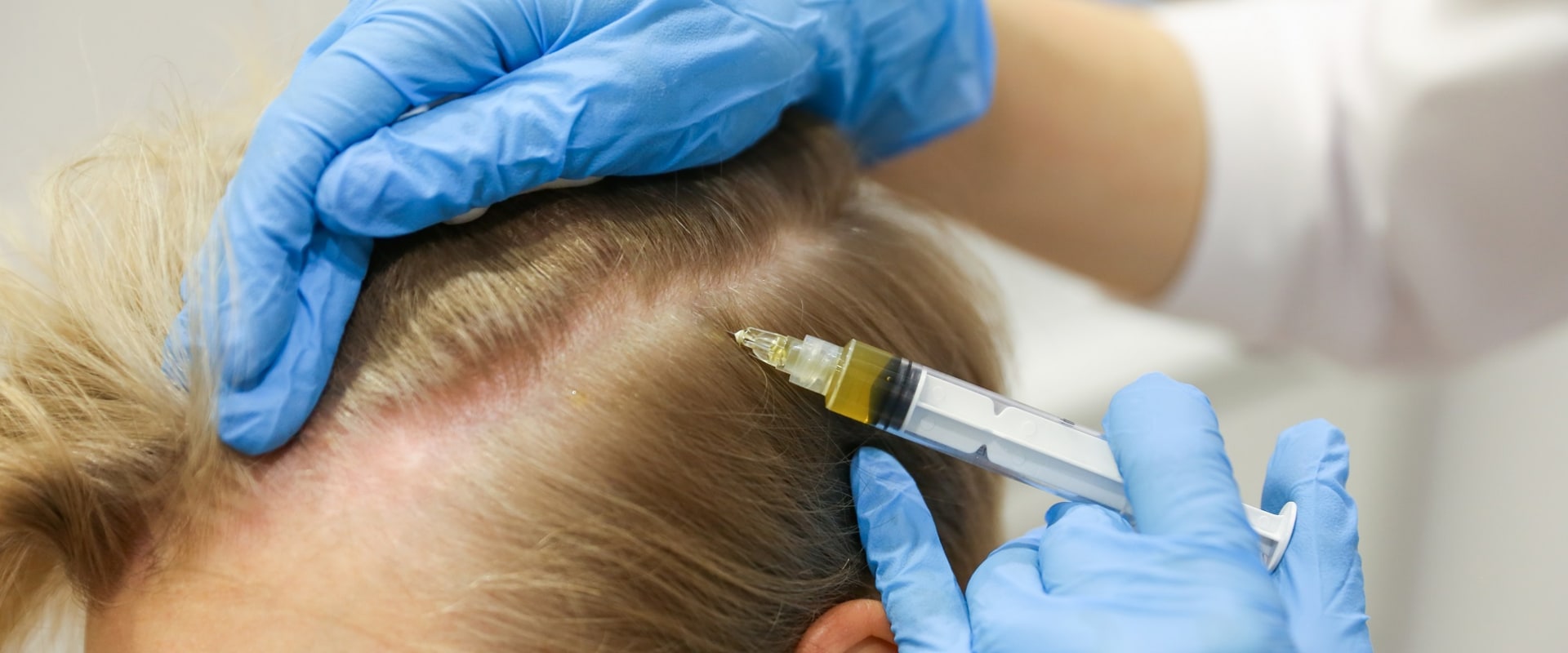 A Comprehensive Guide to Hair Transplants
