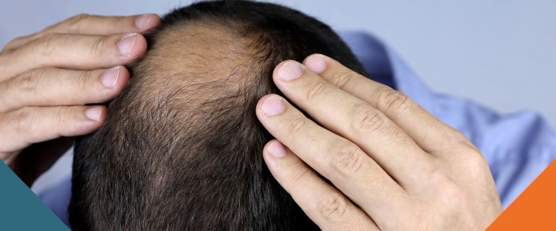 Hair Care Routine for Managing Male Pattern Baldness