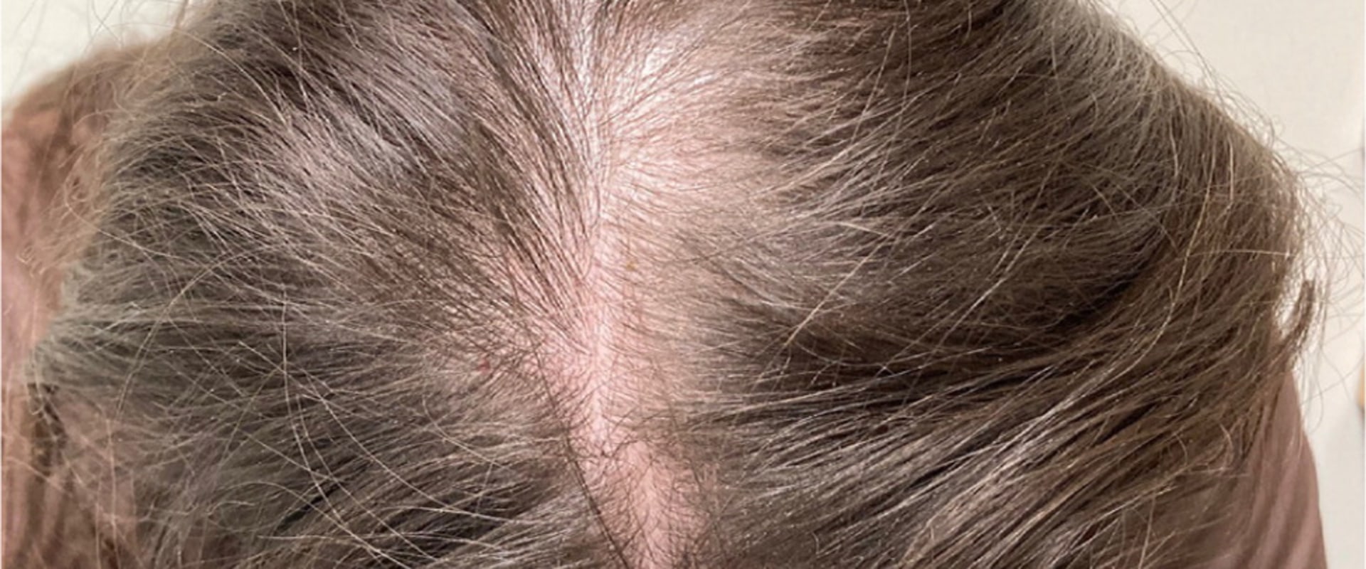 Diagnosing Female Hair Loss: Causes, Solutions, and Treatments