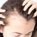 Female Hair Loss: Causes, Prevention, and Treatment