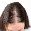 Scalp Care: Understanding Baldness and Hair Loss