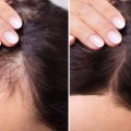 Preventing Hair Loss and Baldness: Causes, Treatments, and Solutions