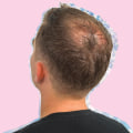Understanding Male Pattern Baldness: Causes, Prevention, and Treatment