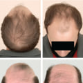 Natural Remedies for Male Pattern Baldness: Tips and Treatments