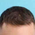 Finasteride: A Comprehensive Guide to Hair Loss Prevention and Treatment