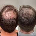 Exercise for Hair Health: Tips and Techniques to Prevent and Treat Hair Loss