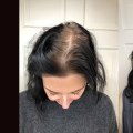 All You Need to Know About Scalp Concealers: Solutions for Hair Loss and Baldness