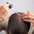 Understanding Genetics: The Key to Preventing Baldness and Hair Loss