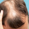 Preventing Baldness and Hair Loss: Understanding the Lifestyle Factors