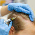 A Comprehensive Guide to Hair Transplants
