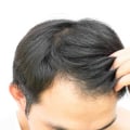 Preventing Hair Loss: Lifestyle Changes That Can Make a Difference