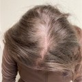 Diagnosing Female Hair Loss: Causes, Solutions, and Treatments