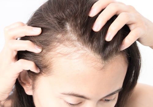 Female Hair Loss: Causes, Prevention, and Treatment