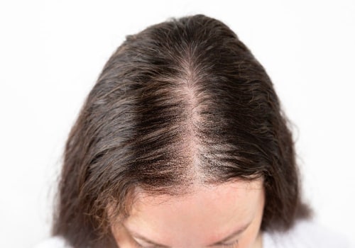 Scalp Care: Understanding Baldness and Hair Loss