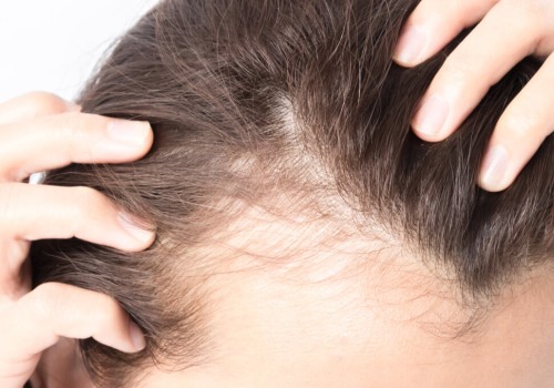 All You Need to Know About Medical Conditions and Female Hair Loss