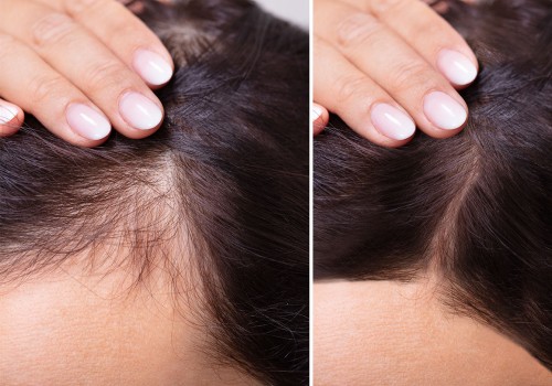 Preventing Hair Loss and Baldness: Causes, Treatments, and Solutions