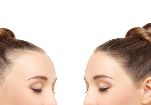 Hormonal Changes: Understanding Hair Loss and Baldness Prevention