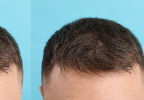 Finasteride: A Comprehensive Guide to Hair Loss Prevention and Treatment