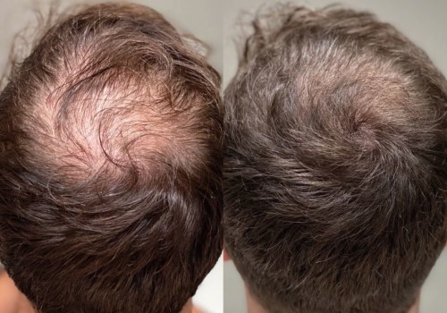 Exercise for Hair Health: Tips and Techniques to Prevent and Treat Hair Loss