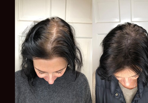 All You Need to Know About Scalp Concealers: Solutions for Hair Loss and Baldness