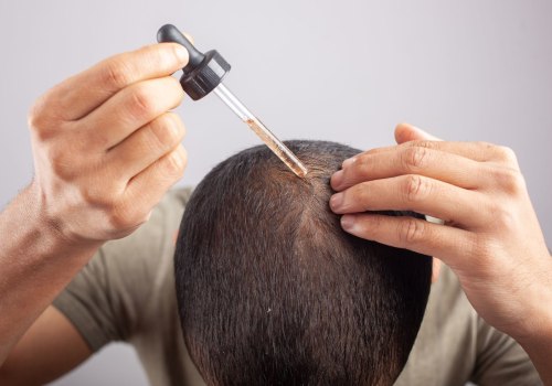 Understanding Genetics: The Key to Preventing Baldness and Hair Loss