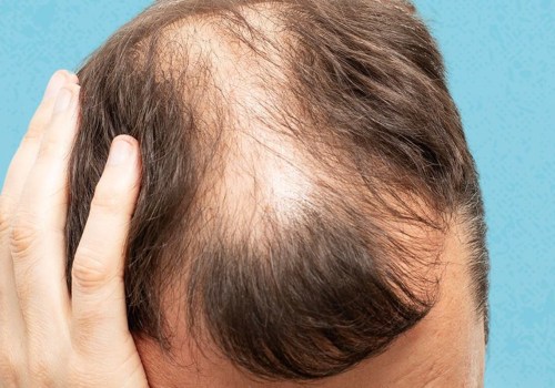Preventing Baldness and Hair Loss: Understanding the Lifestyle Factors