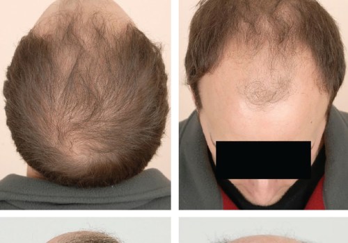 Understanding Male Pattern Baldness and Available Treatments