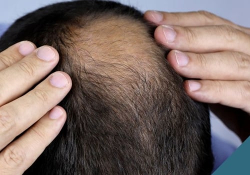 Hair Care Routine for Managing Male Pattern Baldness