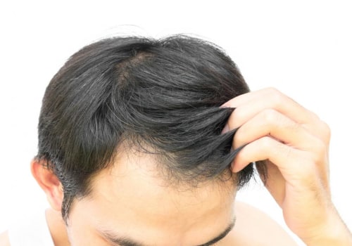 Preventing Hair Loss: Lifestyle Changes That Can Make a Difference
