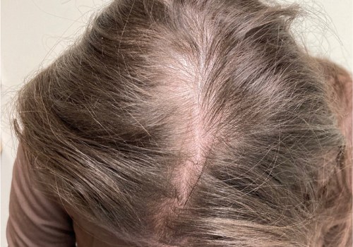 Diagnosing Female Hair Loss: Causes, Solutions, and Treatments
